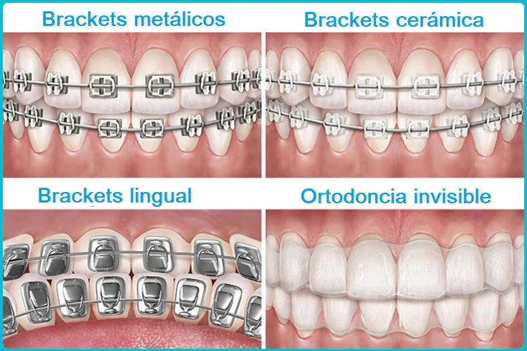 Clinica dental ortodoncia en benetusser